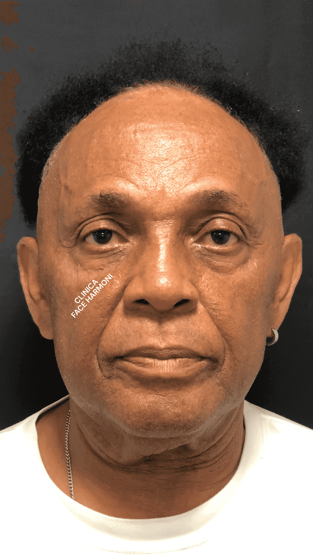 Antes - Harmonização Facial