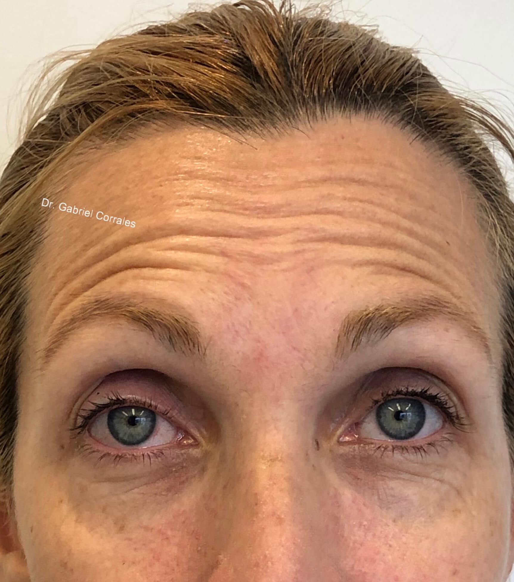 Antes - Toxina Botulínica (Botox)