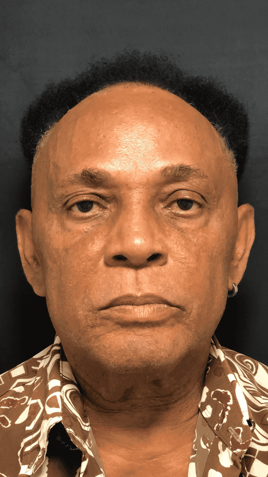 Depois - Harmonização Facial