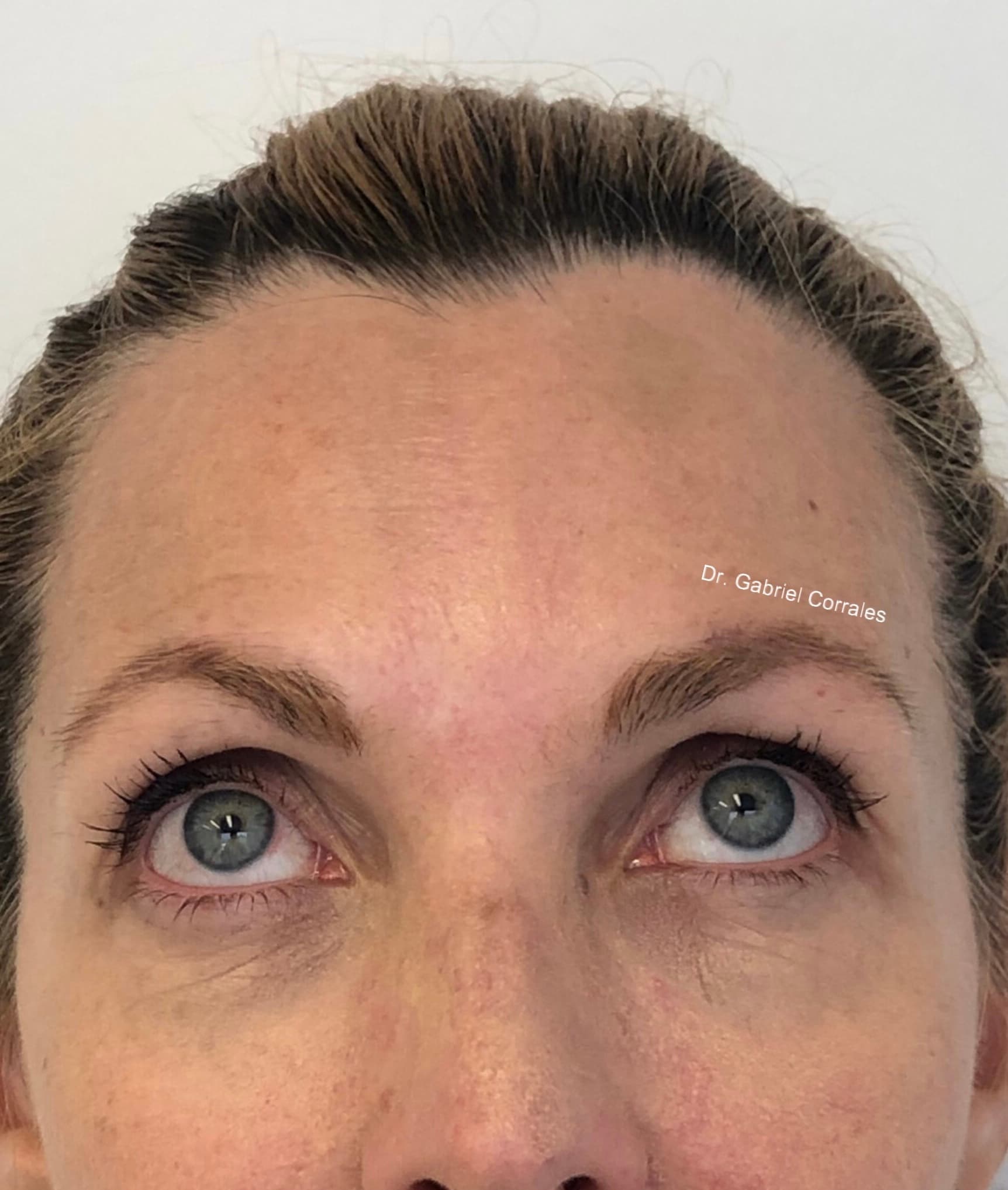 Depois - Toxina Botulínica (Botox)